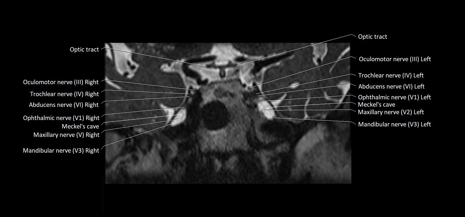 Cranial nerve cross sectional anatomy coronal 3T MRI image 30.webp
